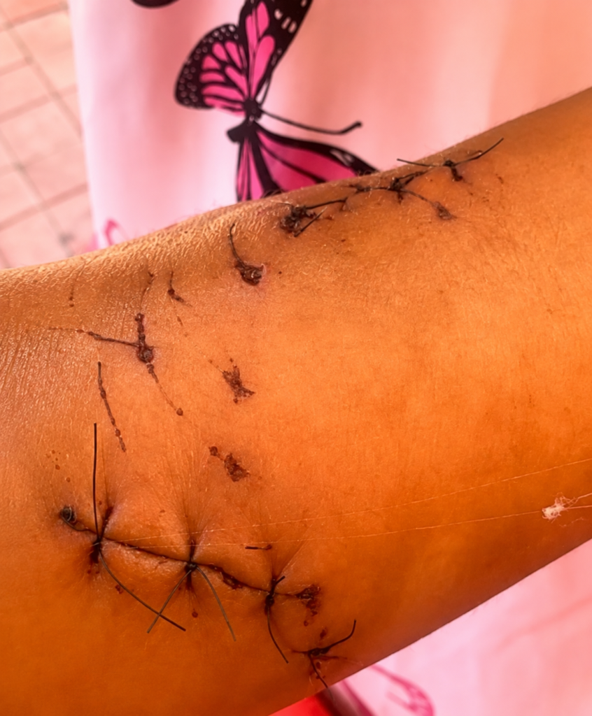 Criança de 6 anos é atacada por jacaré em lago no Setor Solar Marista, em Redenção