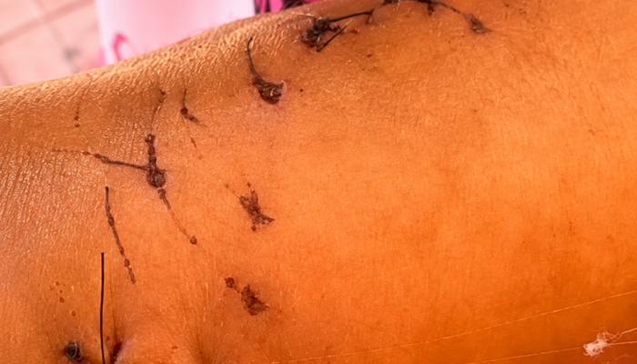 Criança de 6 anos é atacada por jacaré em lago no Setor Solar Marista, em Redenção